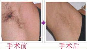 深圳美容 注射botox除腋臭有什么好处