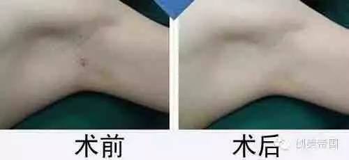 肉毒素祛腋臭