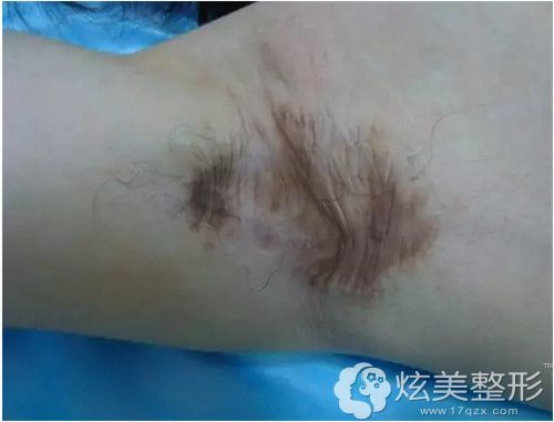 看到激光去大汗腺的效果就超后悔之前做的微创腋臭手术