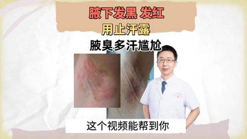 狐臭用完外用产品后出现发红 发痒 发黑怎么处理